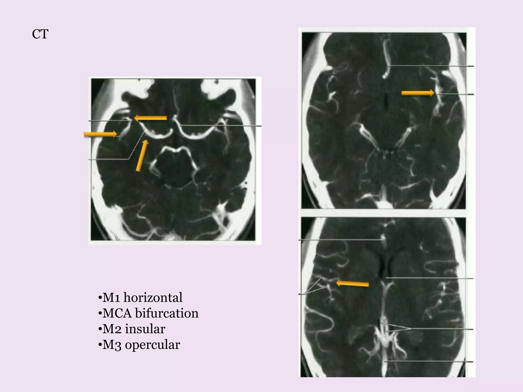 Lateral
•M1 horizontal
•MCA bifurcation
•M2 insular
•M3 opercular
CT
 