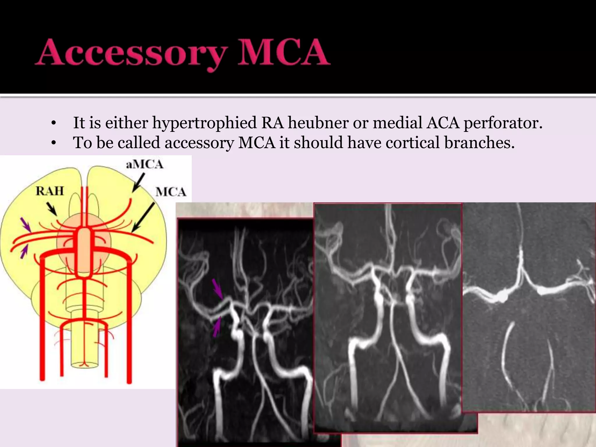 • It is either hypertrophied RA heubner or medial ACA perforator.
• To be called accessory MCA it should have cortical branches.
 