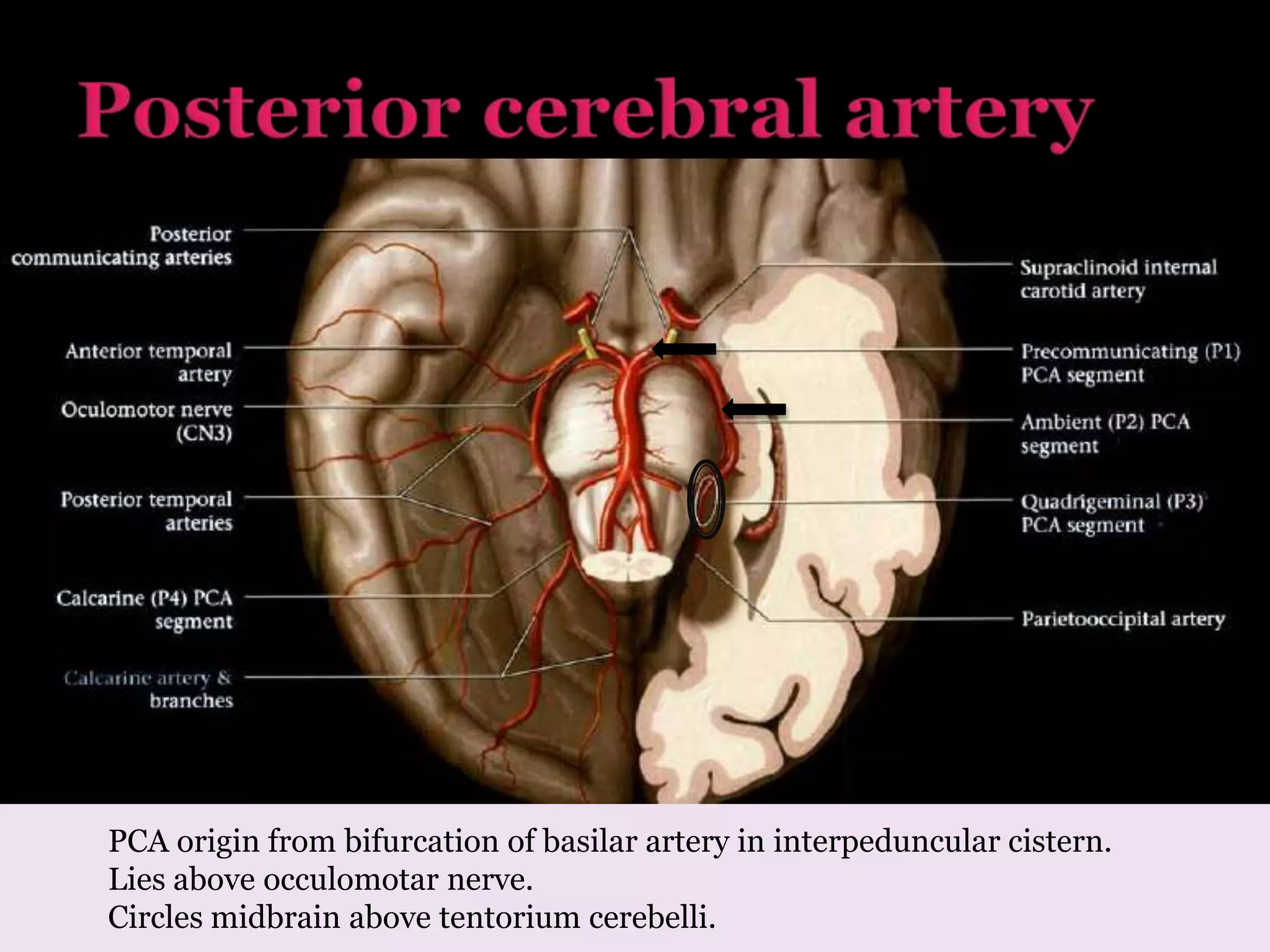 PCA origin from bifurcation of basilar artery in interpeduncular cistern.
Lies above occulomotar nerve.
Circles midbrain above tentorium cerebelli.
 