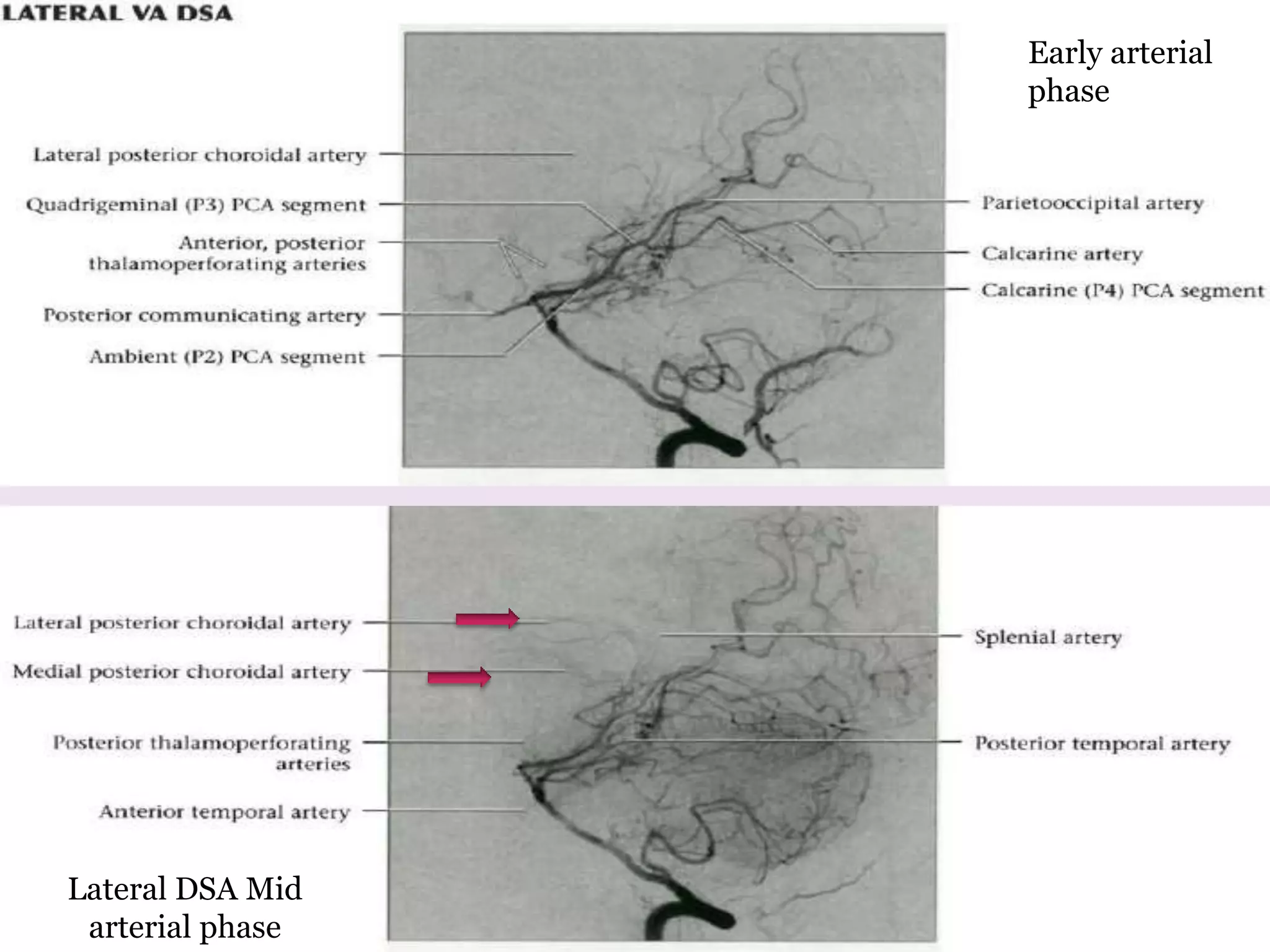 Early arterial
phase
Lateral DSA Mid
arterial phase
 
