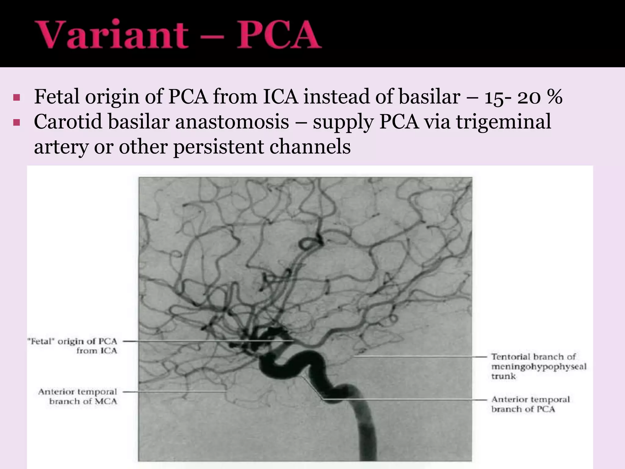  Fetal origin of PCA from ICA instead of basilar – 15- 20 %
 Carotid basilar anastomosis – supply PCA via trigeminal
artery or other persistent channels
 