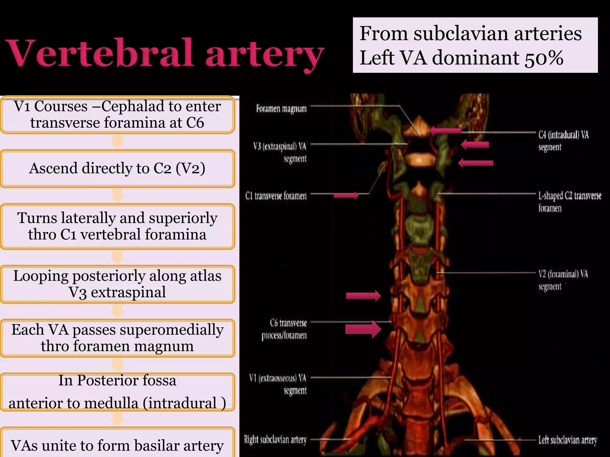 V1 Courses –Cephalad to enter
transverse foramina at C6
Ascend directly to C2 (V2)
Turns laterally and superiorly
thro C1 vertebral foramina
Looping posteriorly along atlas
V3 extraspinal
Each VA passes superomedially
thro foramen magnum
In Posterior fossa
anterior to medulla (intradural )
VAs unite to form basilar artery
From subclavian arteries
Left VA dominant 50%
 
