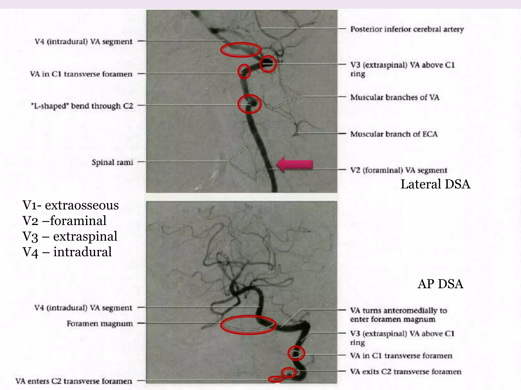 Lateral DSA
AP DSA
V1- extraosseous
V2 –foraminal
V3 – extraspinal
V4 – intradural
 