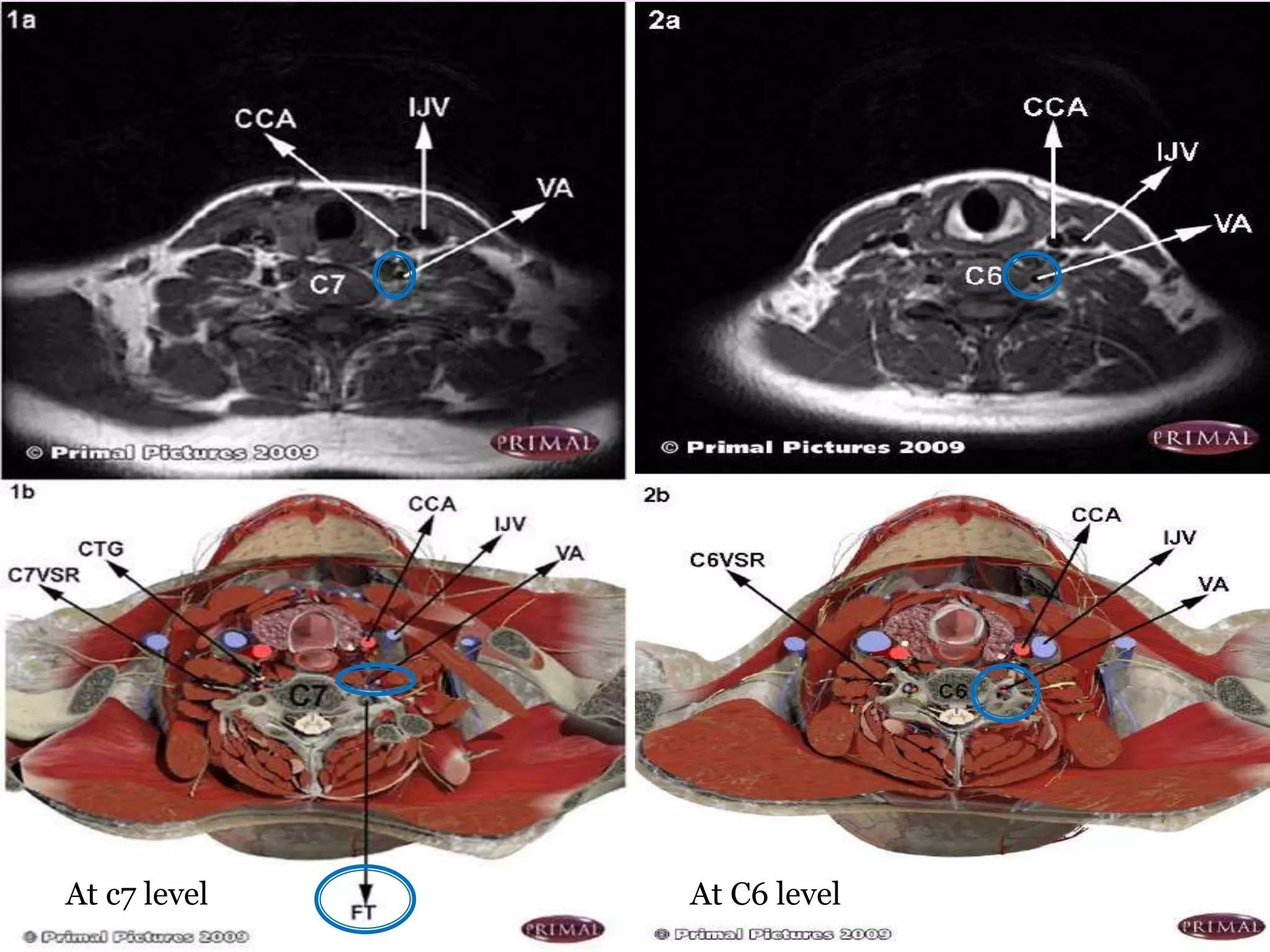 At c7 level At C6 level
 