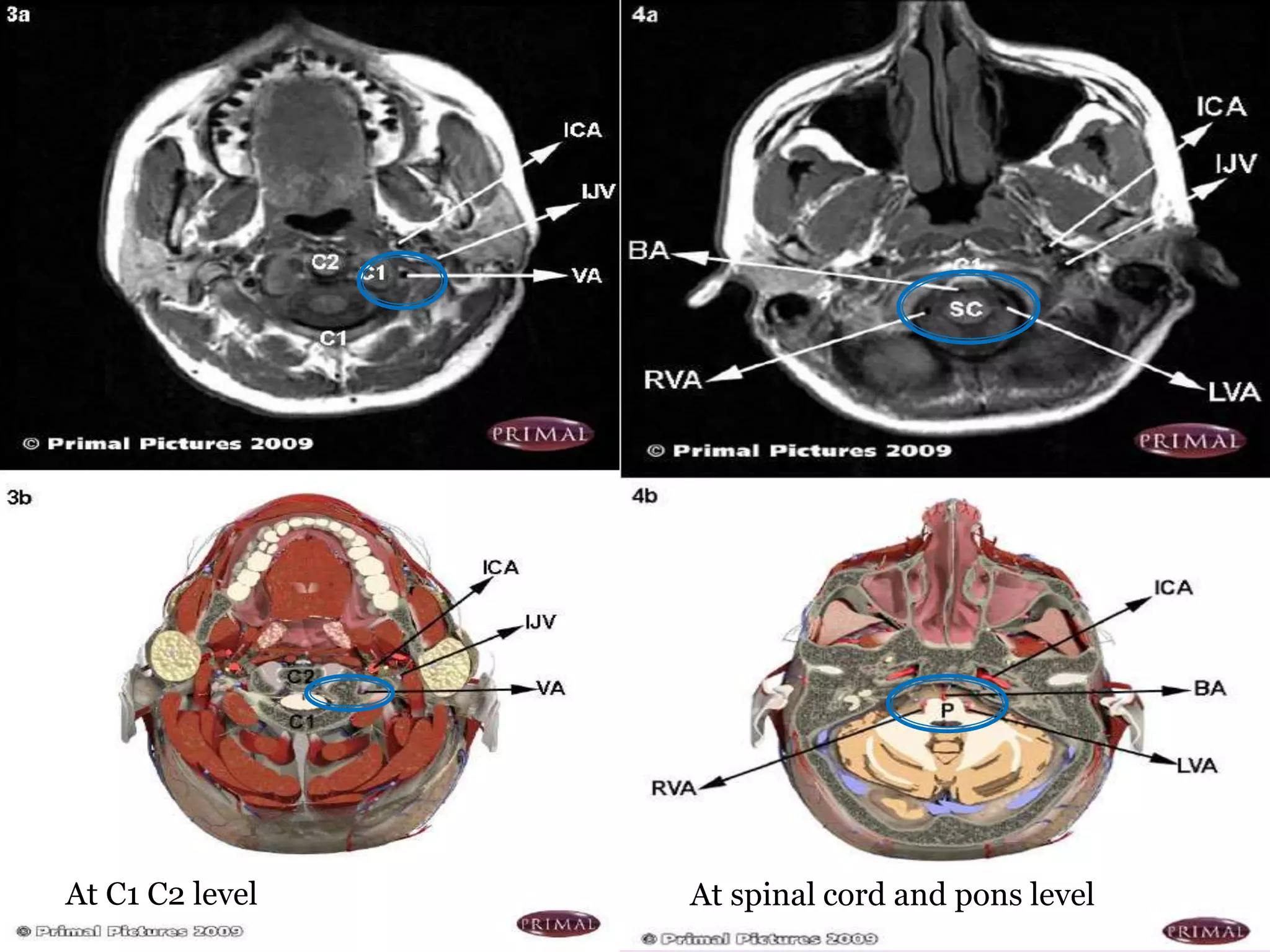 At C1 C2 level At spinal cord and pons level
 
