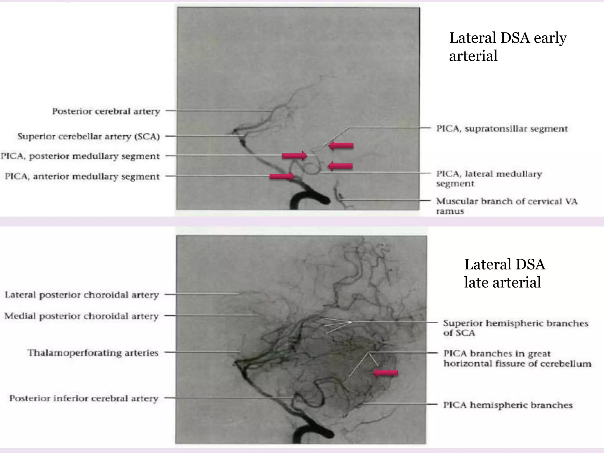 Lateral DSA early
arterial
Lateral DSA
late arterial
 