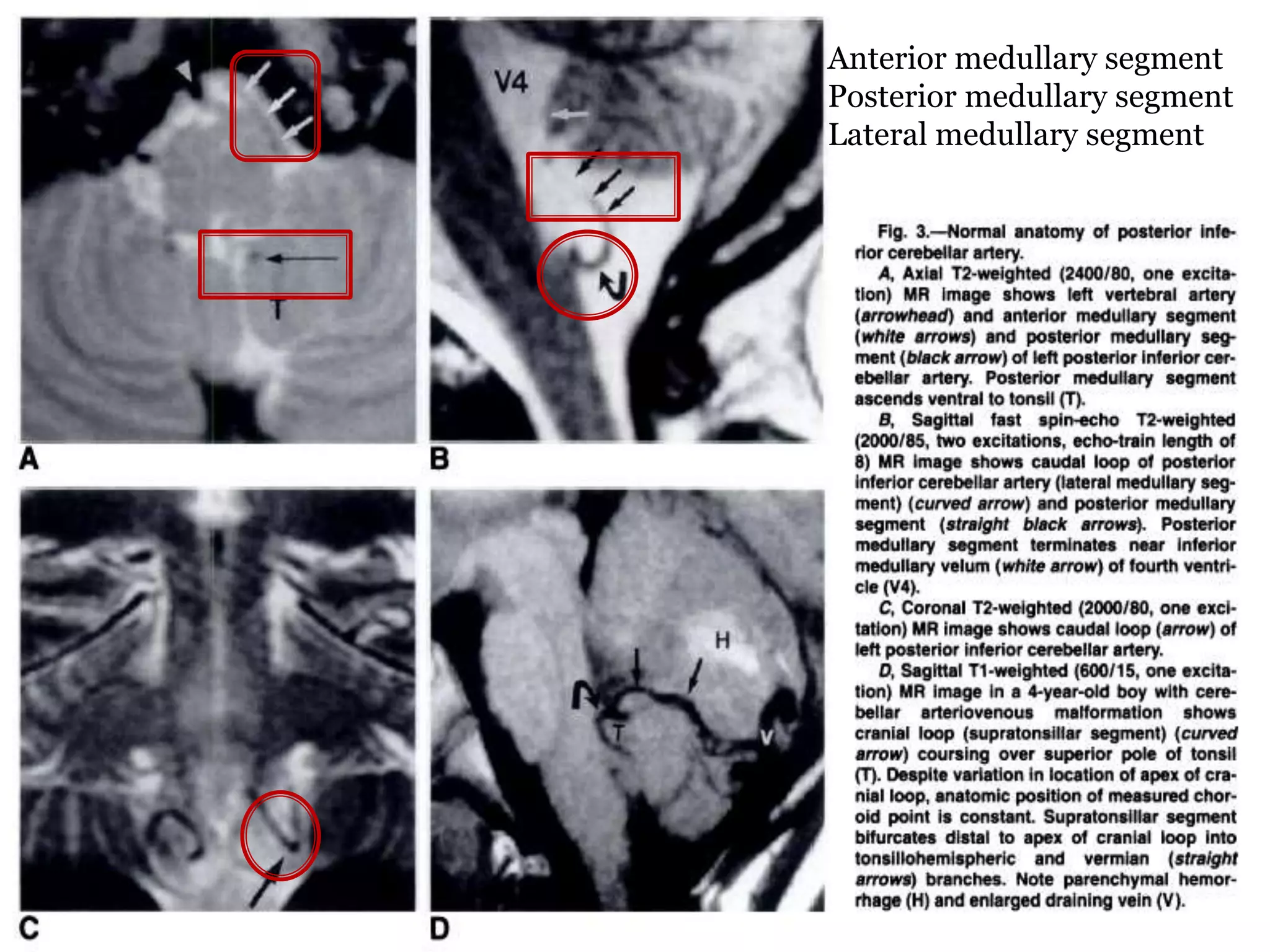 Anterior medullary segment
Posterior medullary segment
Lateral medullary segment
 