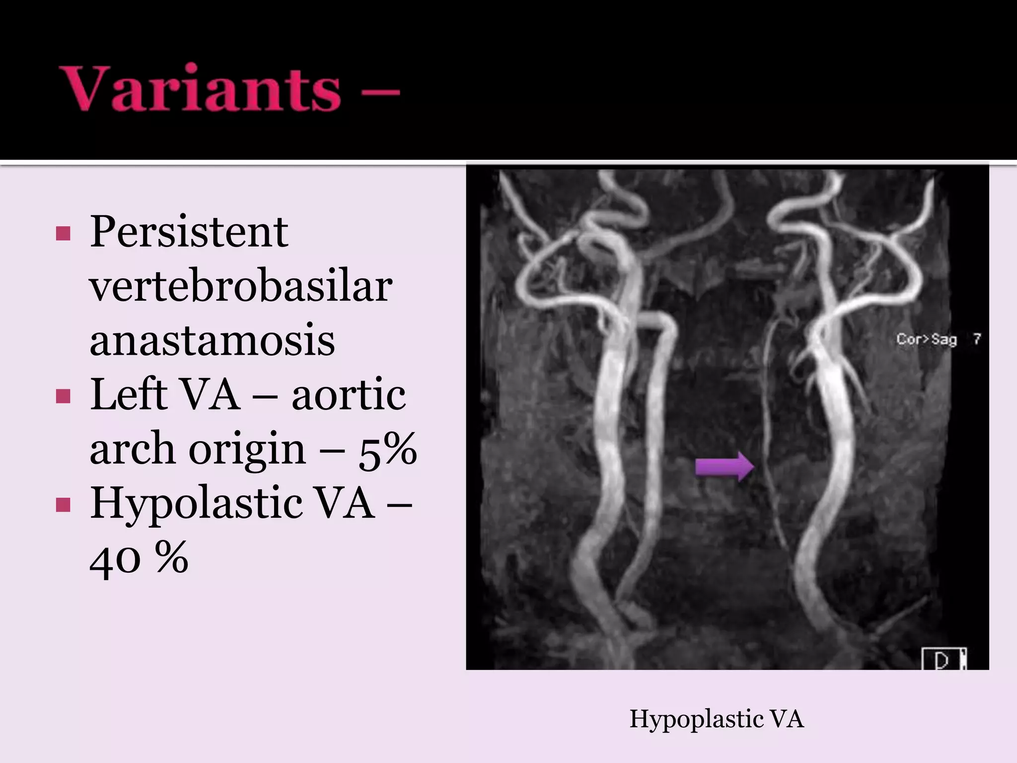  Persistent
vertebrobasilar
anastamosis
 Left VA – aortic
arch origin – 5%
 Hypolastic VA –
40 %
Hypoplastic VA
 