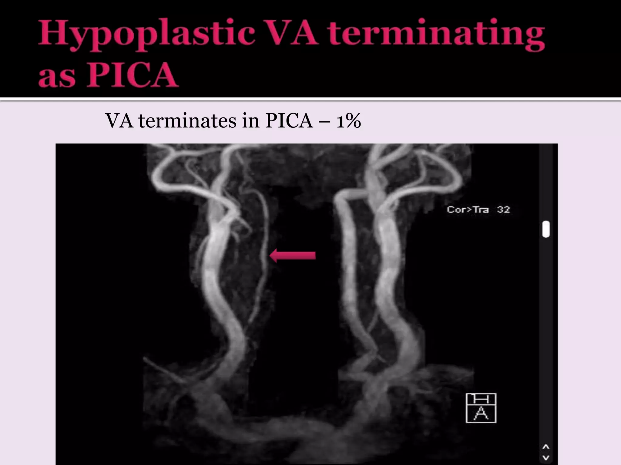 VA terminates in PICA – 1%
 