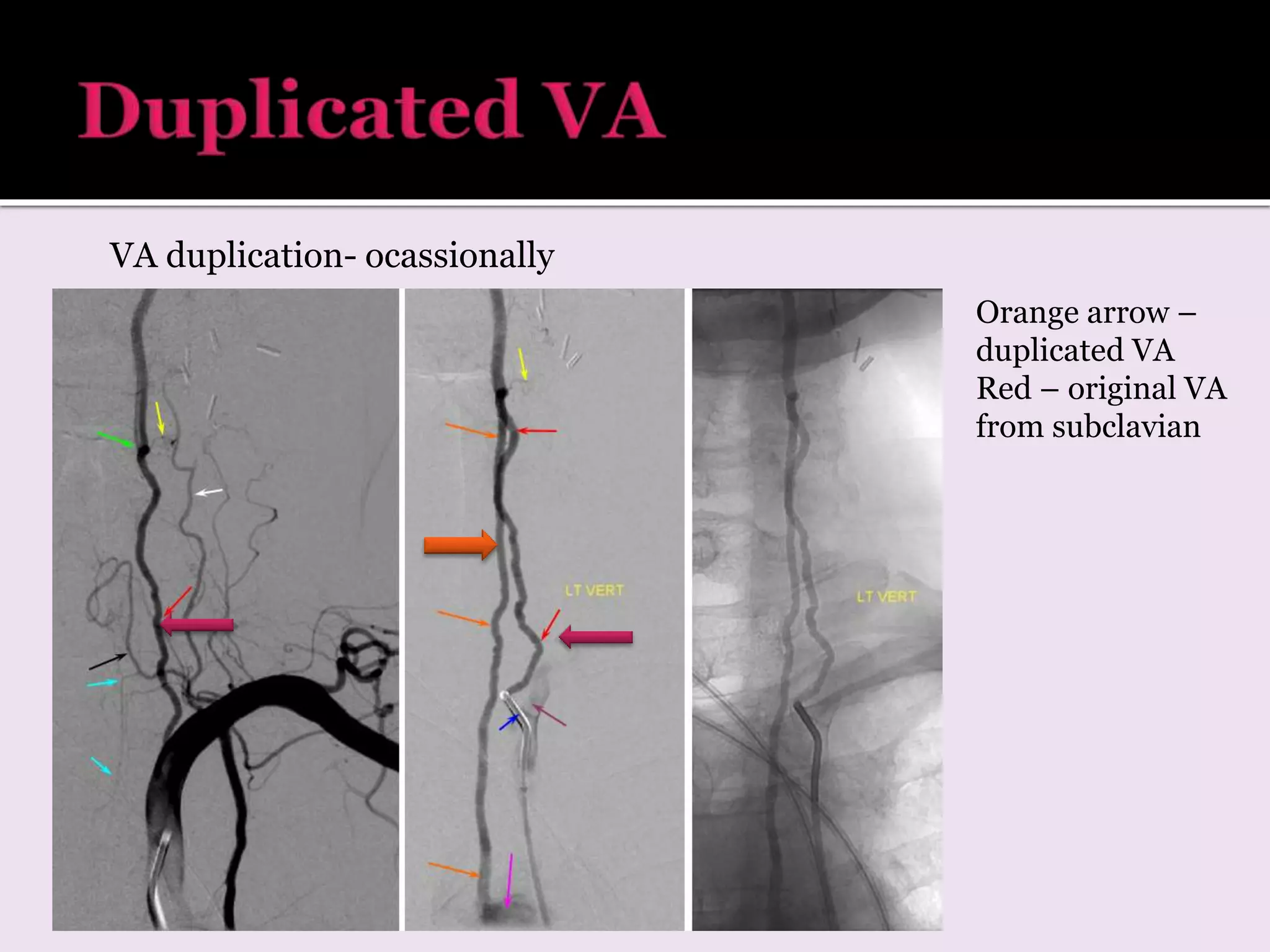 Orange arrow –
duplicated VA
Red – original VA
from subclavian
VA duplication- ocassionally
 