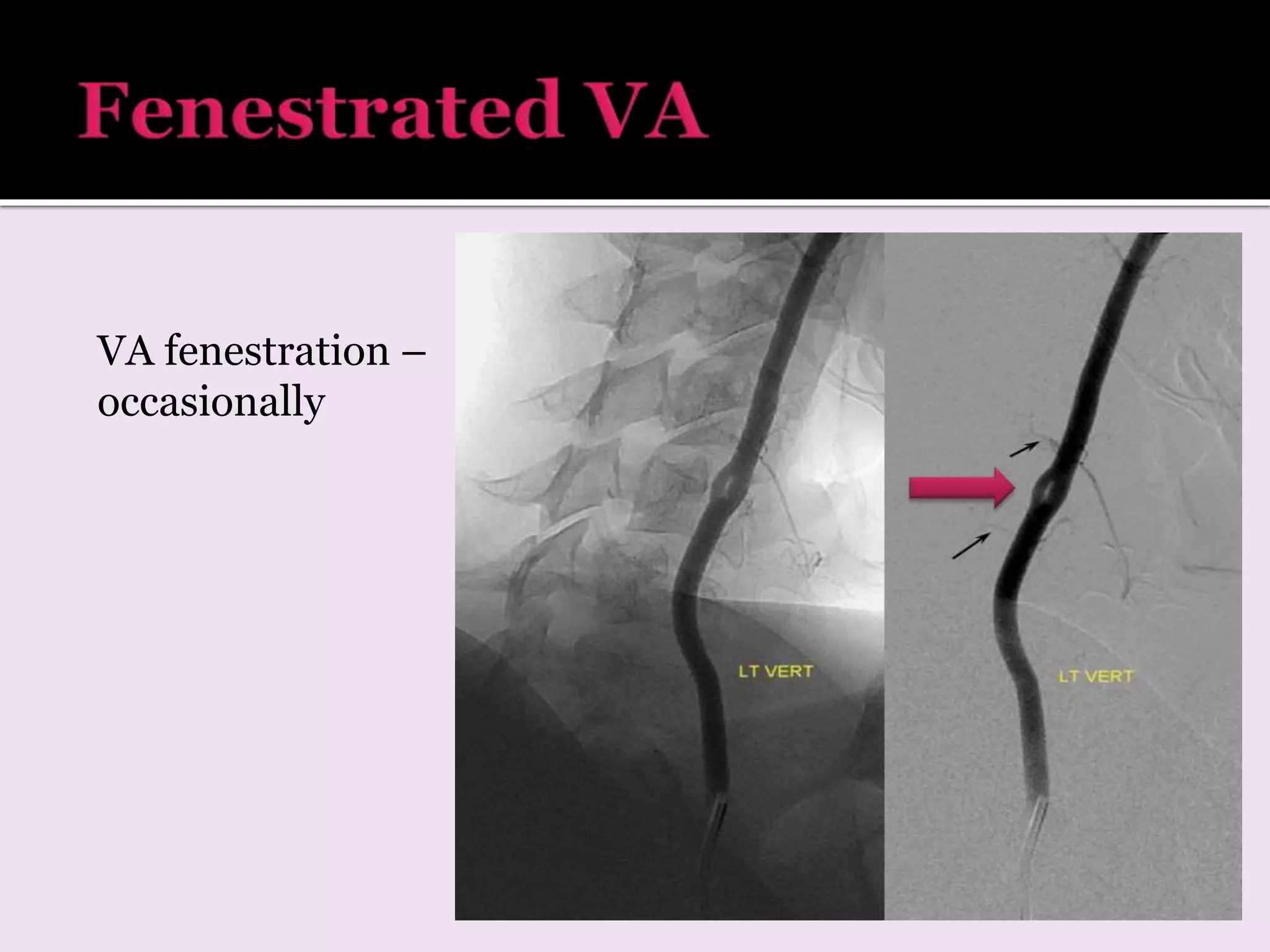 VA fenestration –
occasionally
 