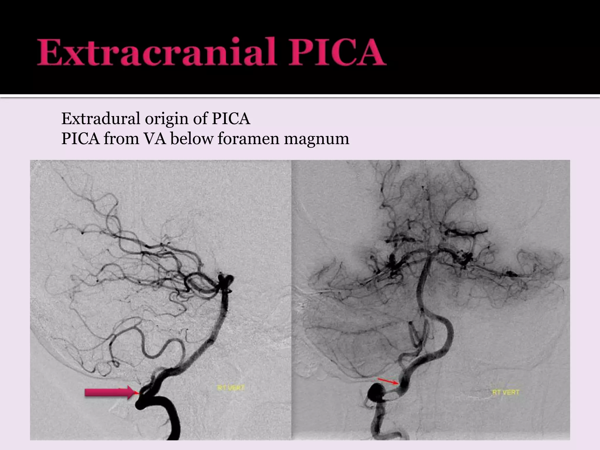 Extradural origin of PICA
PICA from VA below foramen magnum
 