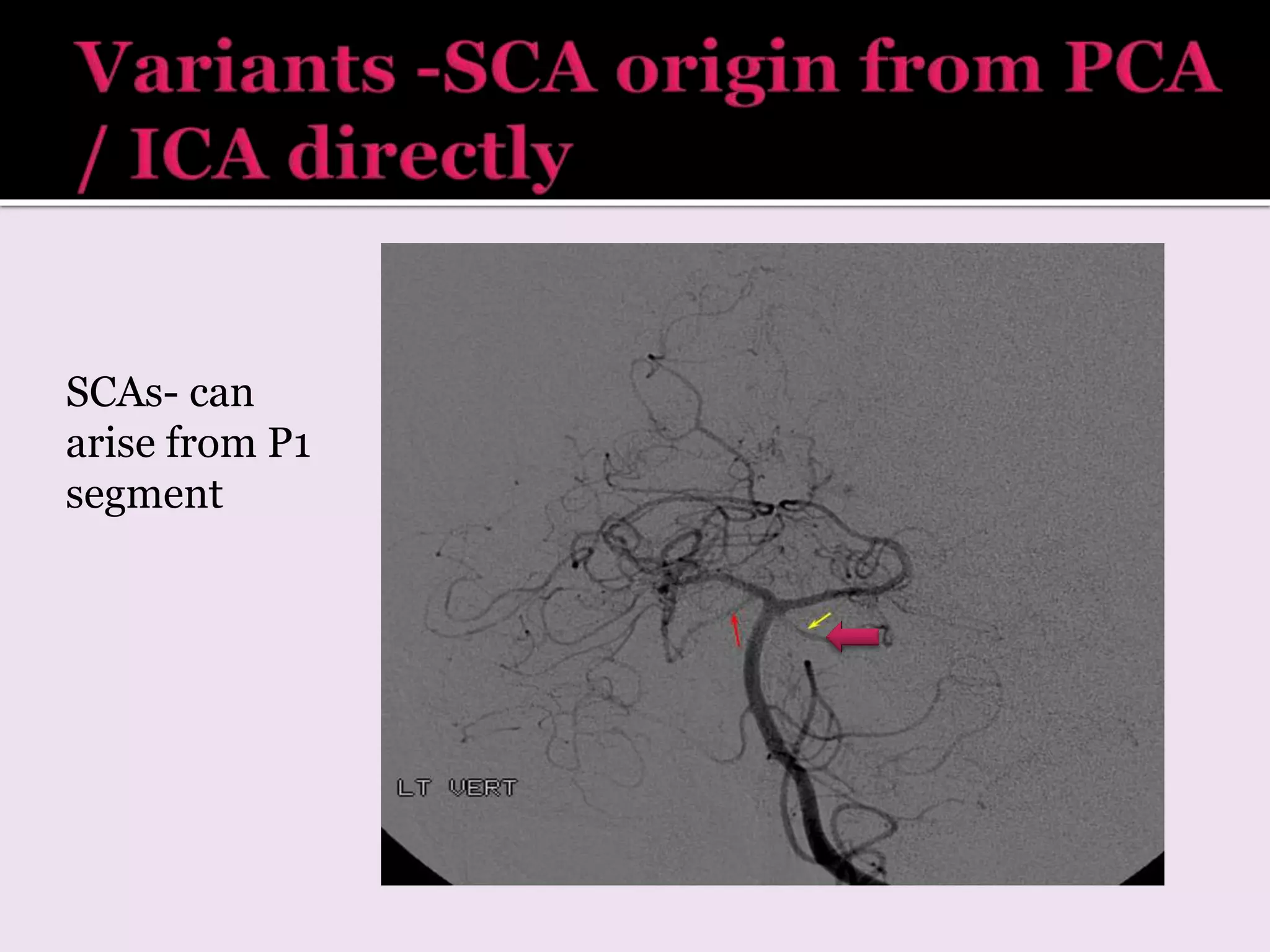 SCAs- can
arise from P1
segment
 
