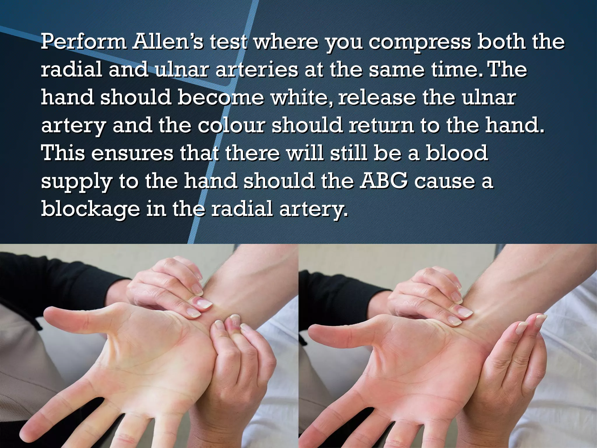 Perform Allen’s test where you compress both thePerform Allen’s test where you compress both the
radial and ulnar arteries at the same time.Theradial and ulnar arteries at the same time.The
hand should become white, release the ulnarhand should become white, release the ulnar
artery and the colour should return to the hand.artery and the colour should return to the hand.
This ensures that there will still be a bloodThis ensures that there will still be a blood
supply to the hand should the ABG cause asupply to the hand should the ABG cause a
blockage in the radial artery.blockage in the radial artery.
 