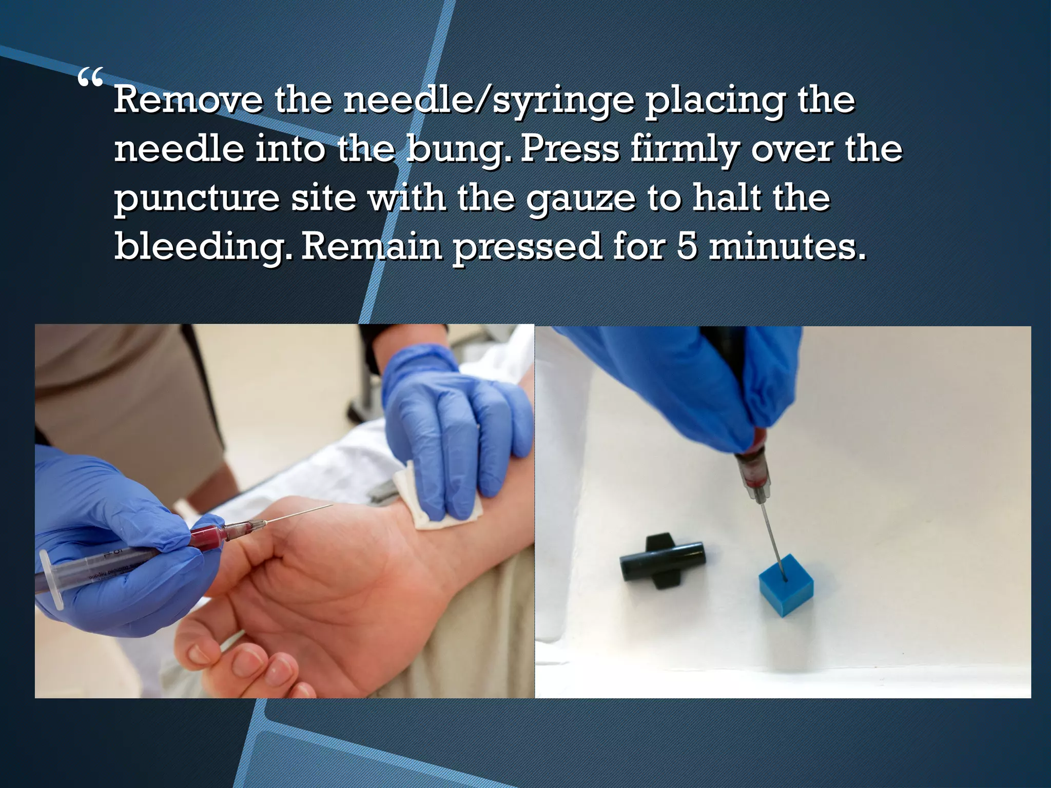 Remove the needle/syringe placing theRemove the needle/syringe placing the
needle into the bung. Press firmly over theneedle into the bung. Press firmly over the
puncture site with the gauze to halt thepuncture site with the gauze to halt the
bleeding. Remain pressed for 5 minutes.bleeding. Remain pressed for 5 minutes.
 