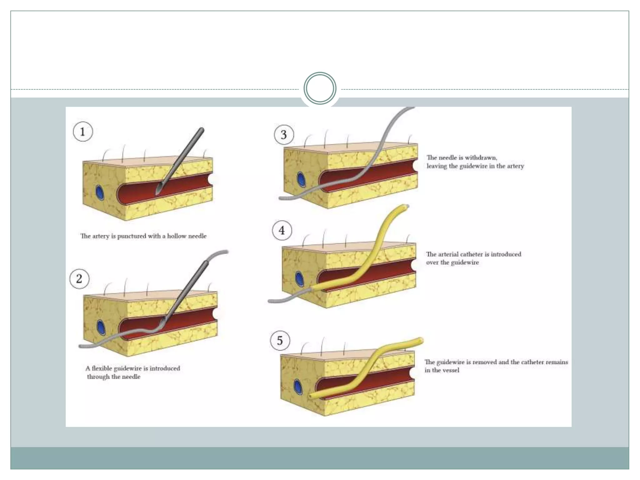 ARTERIAL CANNULATION.pptx