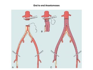 Arterial disease | PDF