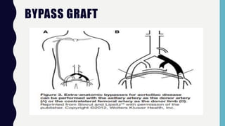 BYPASS GRAFT
 