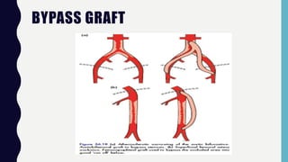 BYPASS GRAFT
 