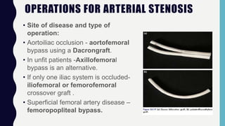 OPERATIONS FOR ARTERIAL STENOSIS
• Site of disease and type of
operation:
• Aortoiliac occlusion - aortofemoral
bypass using a Dacrongraft.
• In unfit patients -Axillofemoral
bypass is an alternative.
• If only one iliac system is occluded-
iliofemoral or femorofemoral
crossover graft .
• Superficial femoral artery disease –
femoropopliteal bypass.
 