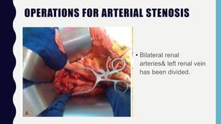 OPERATIONS FOR ARTERIAL STENOSIS
• Bilateral renal
arteries& left renal vein
has been divided.
 