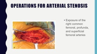 OPERATIONS FOR ARTERIAL STENOSIS
• Exposure of the
right common
femoral, profunda,
and superficial
femoral arteries
 