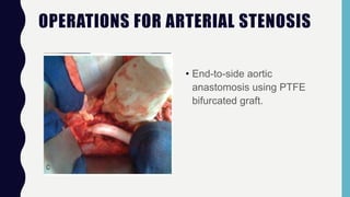 OPERATIONS FOR ARTERIAL STENOSIS
• End-to-side aortic
anastomosis using PTFE
bifurcated graft.
 