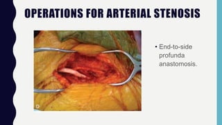 OPERATIONS FOR ARTERIAL STENOSIS
• End-to-side
profunda
anastomosis.
 