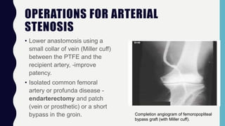 OPERATIONS FOR ARTERIAL
STENOSIS
• Lower anastomosis using a
small collar of vein (Miller cuff)
between the PTFE and the
recipient artery, -improve
patency.
• Isolated common femoral
artery or profunda disease -
endarterectomy and patch
(vein or prosthetic) or a short
bypass in the groin. Completion angiogram of femoropopliteal
bypass graft (with Miller cuff).
 