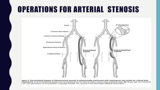 OPERATIONS FOR ARTERIAL STENOSIS
 
