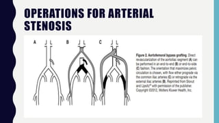OPERATIONS FOR ARTERIAL
STENOSIS
 