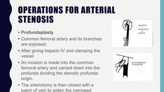 OPERATIONS FOR ARTERIAL
STENOSIS
• Profundaplasty
• Common femoral artery and its branches
are exposed.
• After giving heparin IV and clamping the
vessel
• An incision is made into the common
femoral artery and carried down into the
profunda dividing the stenotic profunda
origin.
• The arteriotomy is then closed with a
patch of vein to widen the narrowed
 