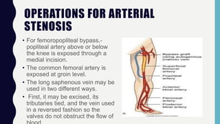 OPERATIONS FOR ARTERIAL
STENOSIS
• For femoropopliteal bypass,-
popliteal artery above or below
the knee is exposed through a
medial incision.
• The common femoral artery is
exposed at groin level.
• The long saphenous vein may be
used in two different ways.
• First, it may be excised, its
tributaries tied, and the vein used
in a reversed fashion so the
valves do not obstruct the flow of
 