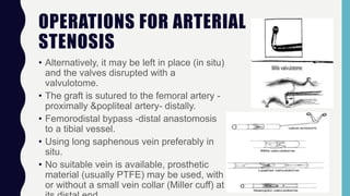 OPERATIONS FOR ARTERIAL
STENOSIS
• Alternatively, it may be left in place (in situ)
and the valves disrupted with a
valvulotome.
• The graft is sutured to the femoral artery -
proximally &popliteal artery- distally.
• Femorodistal bypass -distal anastomosis
to a tibial vessel.
• Using long saphenous vein preferably in
situ.
• No suitable vein is available, prosthetic
material (usually PTFE) may be used, with
or without a small vein collar (Miller cuff) at
 