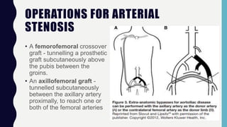 OPERATIONS FOR ARTERIAL
STENOSIS
• A femorofemoral crossover
graft - tunnelling a prosthetic
graft subcutaneously above
the pubis between the
groins.
• An axillofemoral graft -
tunnelled subcutaneously
between the axillary artery
proximally, to reach one or
both of the femoral arteries
 