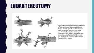 ENDARTERECTOMY
 