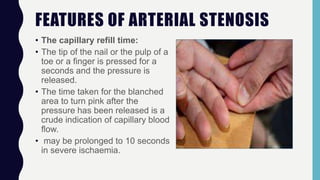 FEATURES OF ARTERIAL STENOSIS
• The capillary refill time:
• The tip of the nail or the pulp of a
toe or a finger is pressed for a
seconds and the pressure is
released.
• The time taken for the blanched
area to turn pink after the
pressure has been released is a
crude indication of capillary blood
flow.
• may be prolonged to 10 seconds
in severe ischaemia.
 