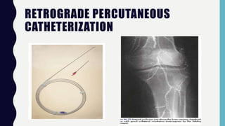 RETROGRADE PERCUTANEOUS
CATHETERIZATION
 