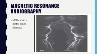 MAGNETIC RESONANCE
ANGIOGRAPHY
• MRA scan -
distal tibial
disease
 