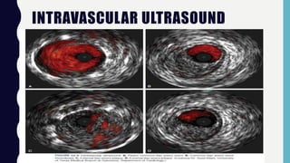 INTRAVASCULAR ULTRASOUND
 