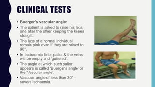 CLINICAL TESTS
• Buerger’s vascular angle:
• The patient is asked to raise his legs
one after the other keeping the knees
straight.
• The legs of a normal individual
remain pink even if they are raised to
90°.
• In ischaemic limb- pallor & the veins
will be empty and 'guttered'.
• The angle at which such pallor
appears is called 'Buerger's angle' or
the 'Vascular angle'.
• Vascular angle of less than 30° -
severe ischaemia.
 