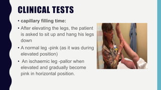 CLINICAL TESTS
• capillary filling time:
• After elevating the legs, the patient
is asked to sit up and hang his legs
down
• A normal leg -pink (as it was during
elevated position)
• An ischaemic leg -pallor when
elevated and gradually become
pink in horizontal position.
 