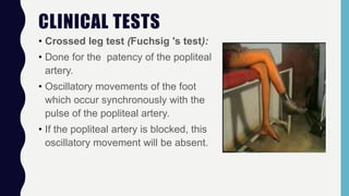CLINICAL TESTS
• Crossed leg test (Fuchsig 's test):
• Done for the patency of the popliteal
artery.
• Oscillatory movements of the foot
which occur synchronously with the
pulse of the popliteal artery.
• If the popliteal artery is blocked, this
oscillatory movement will be absent.
 