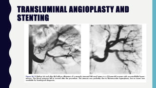 TRANSLUMINAL ANGIOPLASTY AND
STENTING
 
