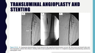 TRANSLUMINAL ANGIOPLASTY AND
STENTING
 