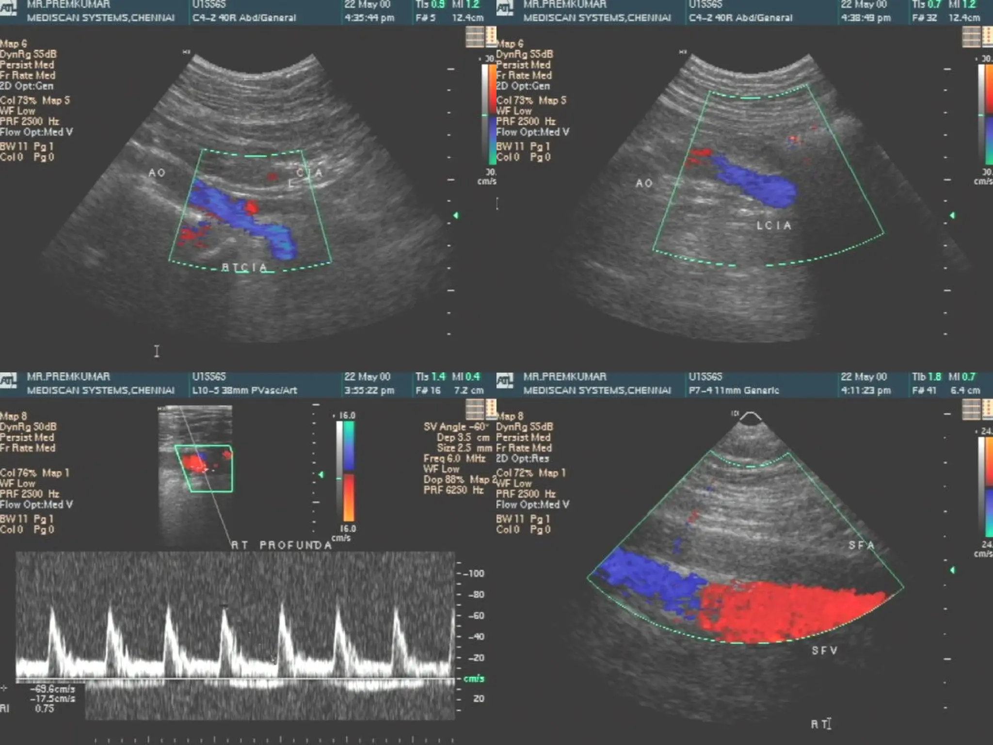 Arterial Dopplers ultrasound by tttttttt