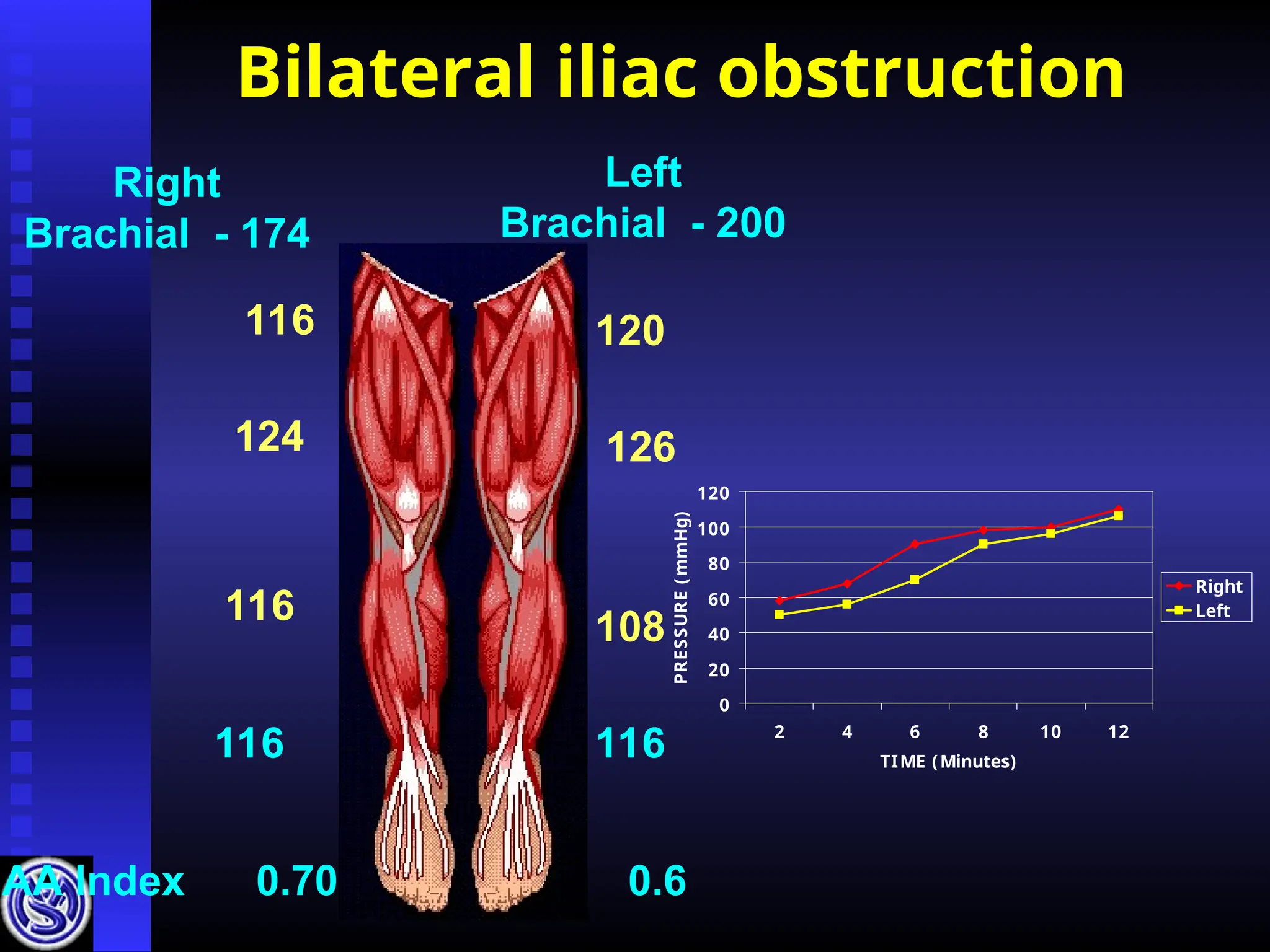 Bilateral iliac obstruction
Right
Brachial - 174
Left
Brachial - 200
116
124
116
116 116
108
126
120
AA Index 0.70 0.6
0
20
40
60
80
100
120
2 4 6 8 10 12
TIME (Minutes)
PRESSURE
(
mmHg)
Right
Left
 
