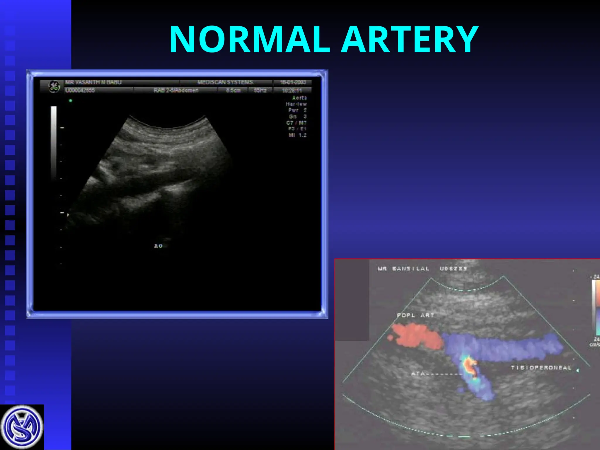 NORMAL ARTERY
 
