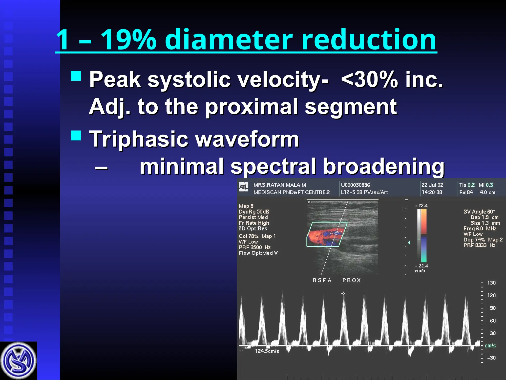 1 – 19% diameter reduction
 Peak systolic velocity- <30% inc.
Peak systolic velocity- <30% inc.
Adj. to the proximal segment
Adj. to the proximal segment
 Triphasic waveform
Triphasic waveform
–
– minimal spectral broadening
minimal spectral broadening
 