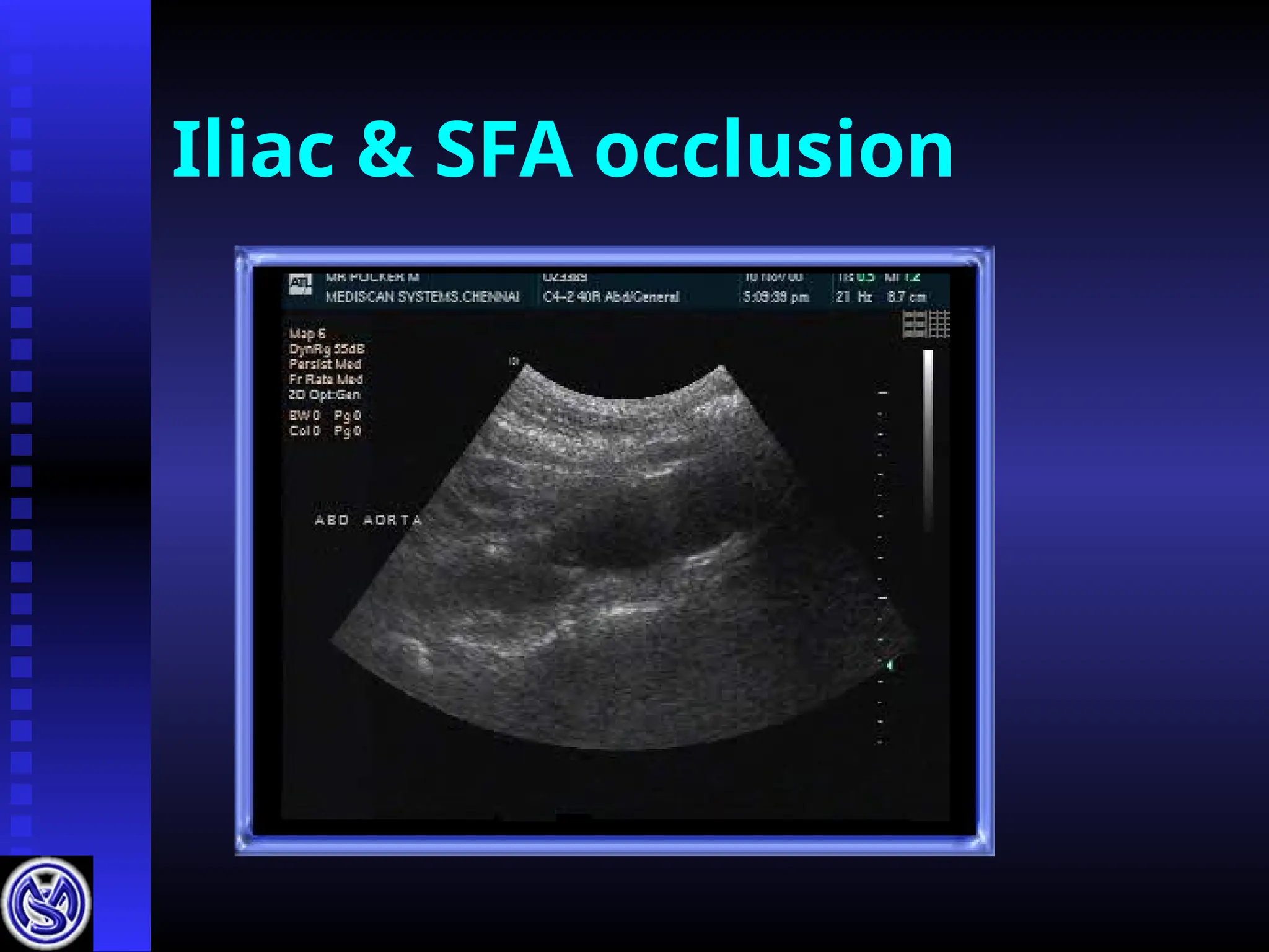 Iliac & SFA occlusion
 